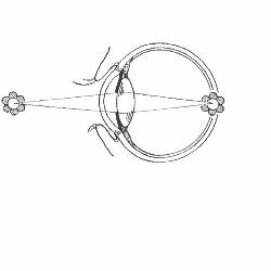 Kurzsichtigkeit (Myopie), weiter Entferntes wird unscharf
